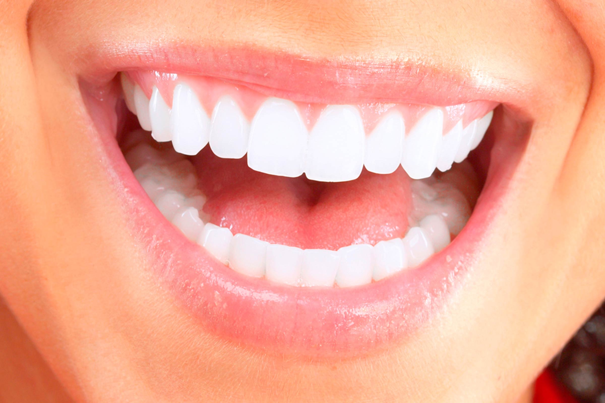 Teeth Whitening Marrickville